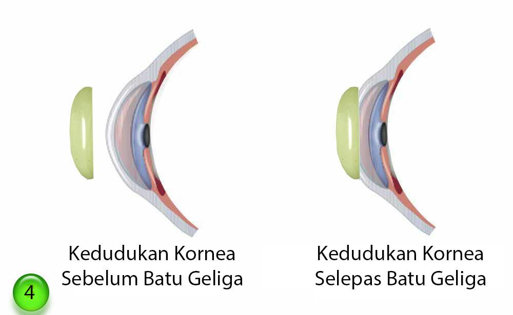 BG04