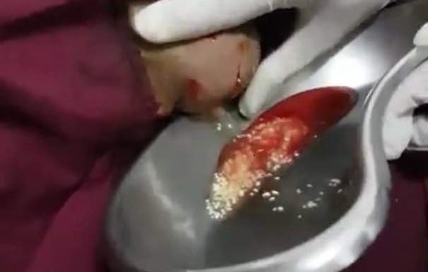 Bedah kaki gout