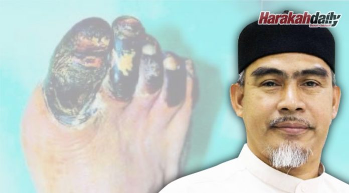 Saraf kencing manis