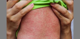 Measles outbreak caused the death of 74 children in North Afghanistan