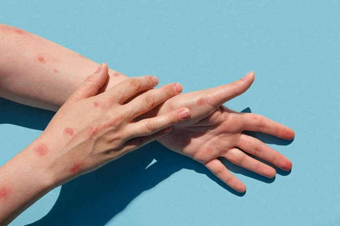 Monkeypox new disease dangerous over the world. Patient with Monkey Pox. Painful rash, red spots blisters on the hand. Close up rash, human hands with Health problem. Banner, copy space