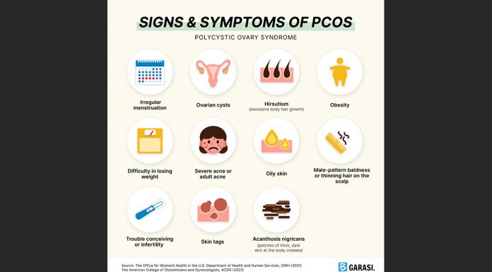 PCOS: The silent epidemic affecting women