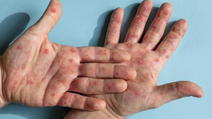 Mpox....