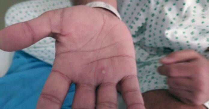 monkeypox