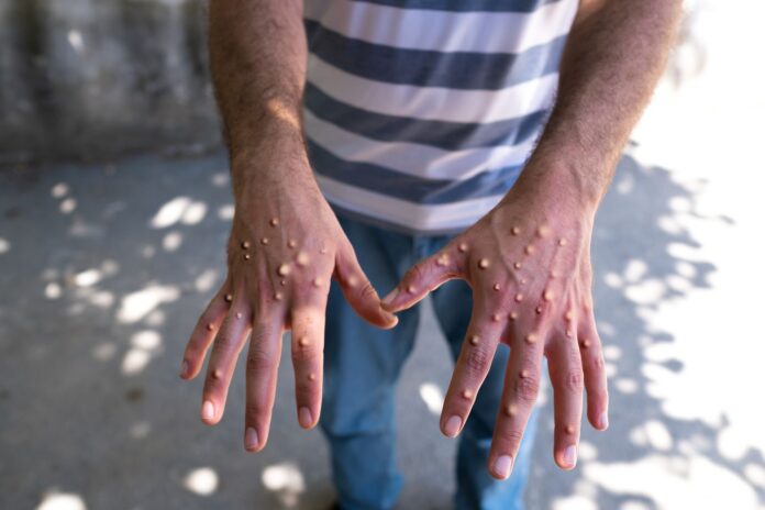 mpox-1