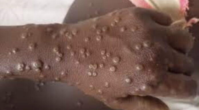 Kes mpox Clade II pertama 2024 di Malaysia dikesan